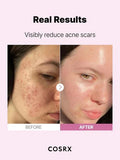 Before and after comparison showing COSRX Niacinamide 15 Serum's visible reduction of acne scars.