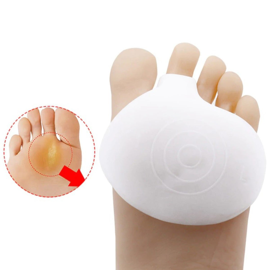 White bunion corrector on a foot with a close-up of a bunions on a white background