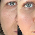 Before and after comparison of a person's eye area with visible skin texture differences.