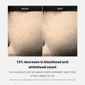 Before and after comparison of blackhead and whitehead count reduction with text indicating a 13% decrease.