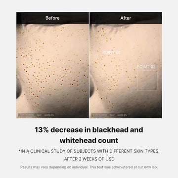 Before and after comparison of blackhead and whitehead count reduction with text indicating a 13% decrease.