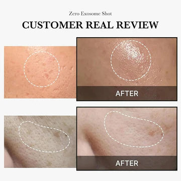 Before and after comparison of skin treatment with 'Zero Exosome Shot' on a customer's skin.