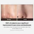 Before and after comparison of skin with pore sizes and blackheads, showing a clinical study result.